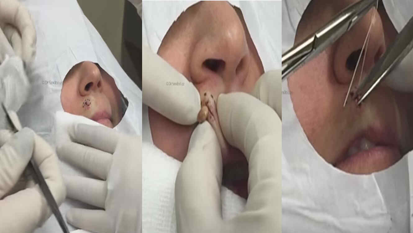 La doctora Sandra Lee saca una espinilla ciega del labio superior de una mujer