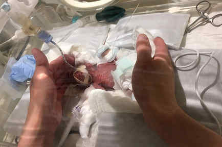 El bebé más pequeño del mundo pesó solo 9,4 onzas al nacer