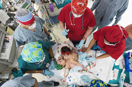 Texas Children&amp;apos;s Hospital Mata conjoined twins