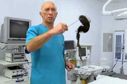 Médicos extraen una bola de pelo del estómago de una niña