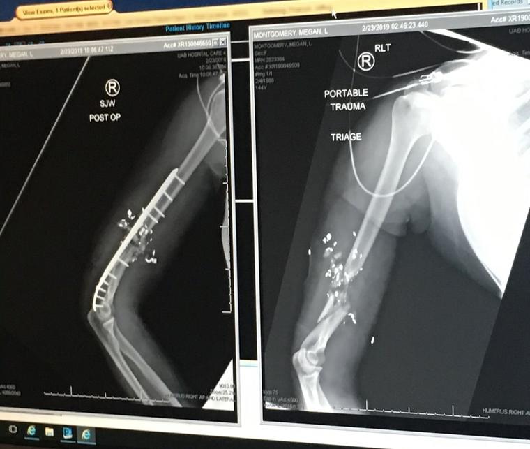 Las radiografías muestran el daño en la parte superior del brazo derecho de Megan Montgomery cuando le disparó su esposo en febrero de 2019 (derecha) y la cirugía para repararlo (izquierda).