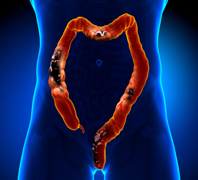 El cáncer colorrectal es el que se origina en el colon o el recto. 