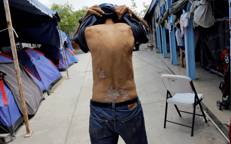 Un inmigrante muestra las lesiones que sufrió a manos de una organización criminal.