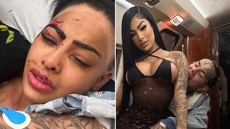 Yailin La Más Viral publica foto con heridas en el rostro y explica qué le sucedió