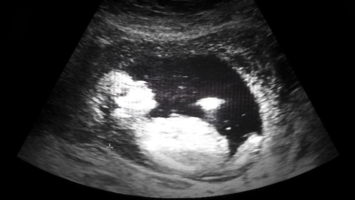 Ecosonograma de bebé en el útero