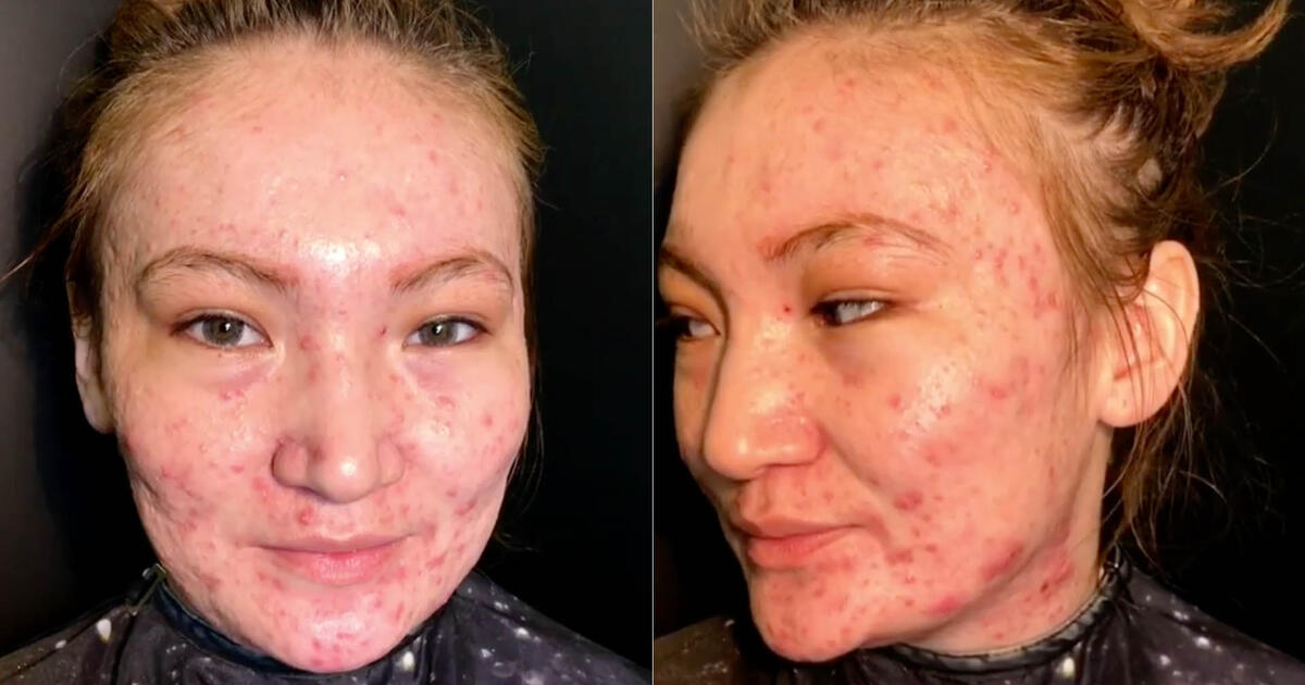 Mira cómo esta mujer consiguió cubrir su acné con maquillaje, el resultado  es increíble