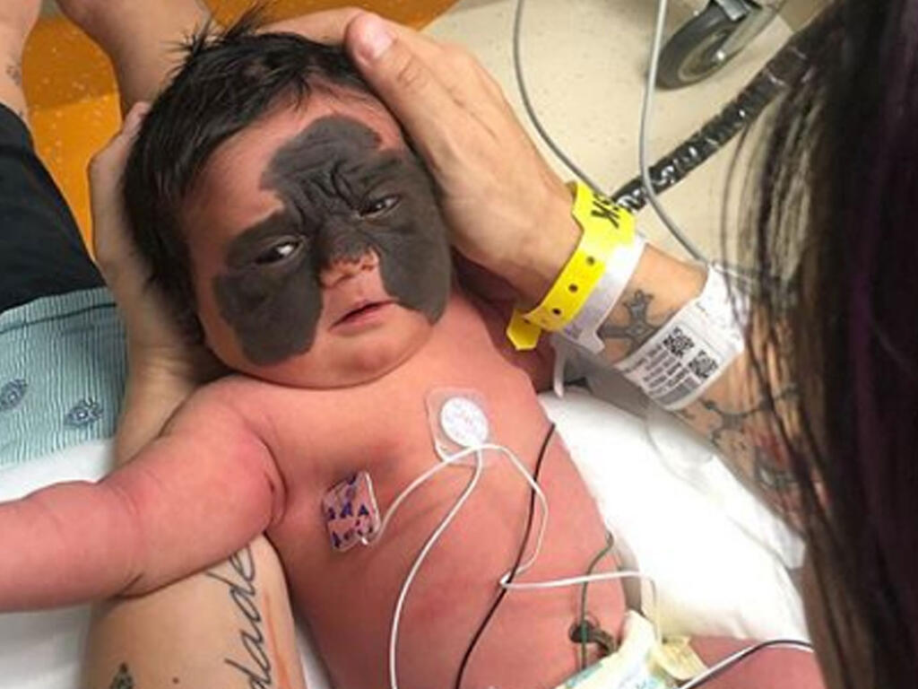 Bebé nace con enorme mancha en la cara y su vida peligra